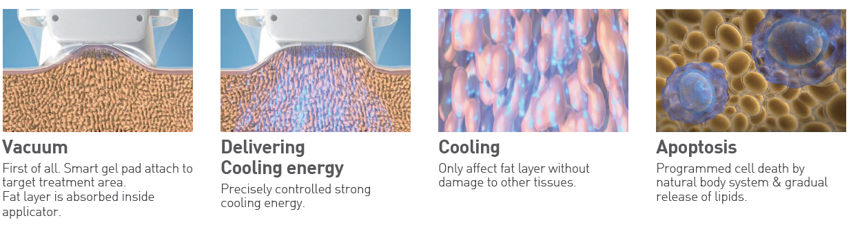 Principles of treatment of MICOOL - A Cryo Fat Reduction Machine