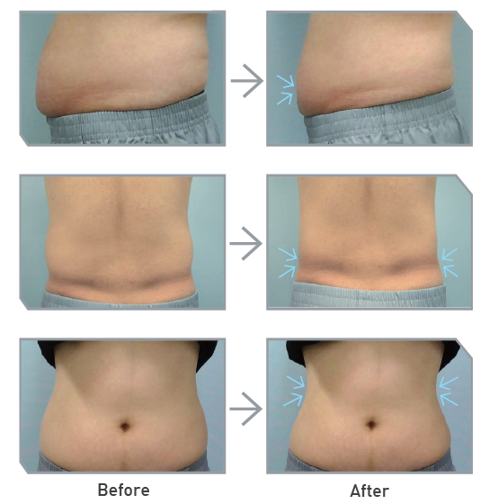 Treatment Results of MICOOL - A Cryo Fat Reduction Machine