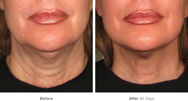 VIOLA Echo - Skin Lifting & Tightening Machine before and after therapy